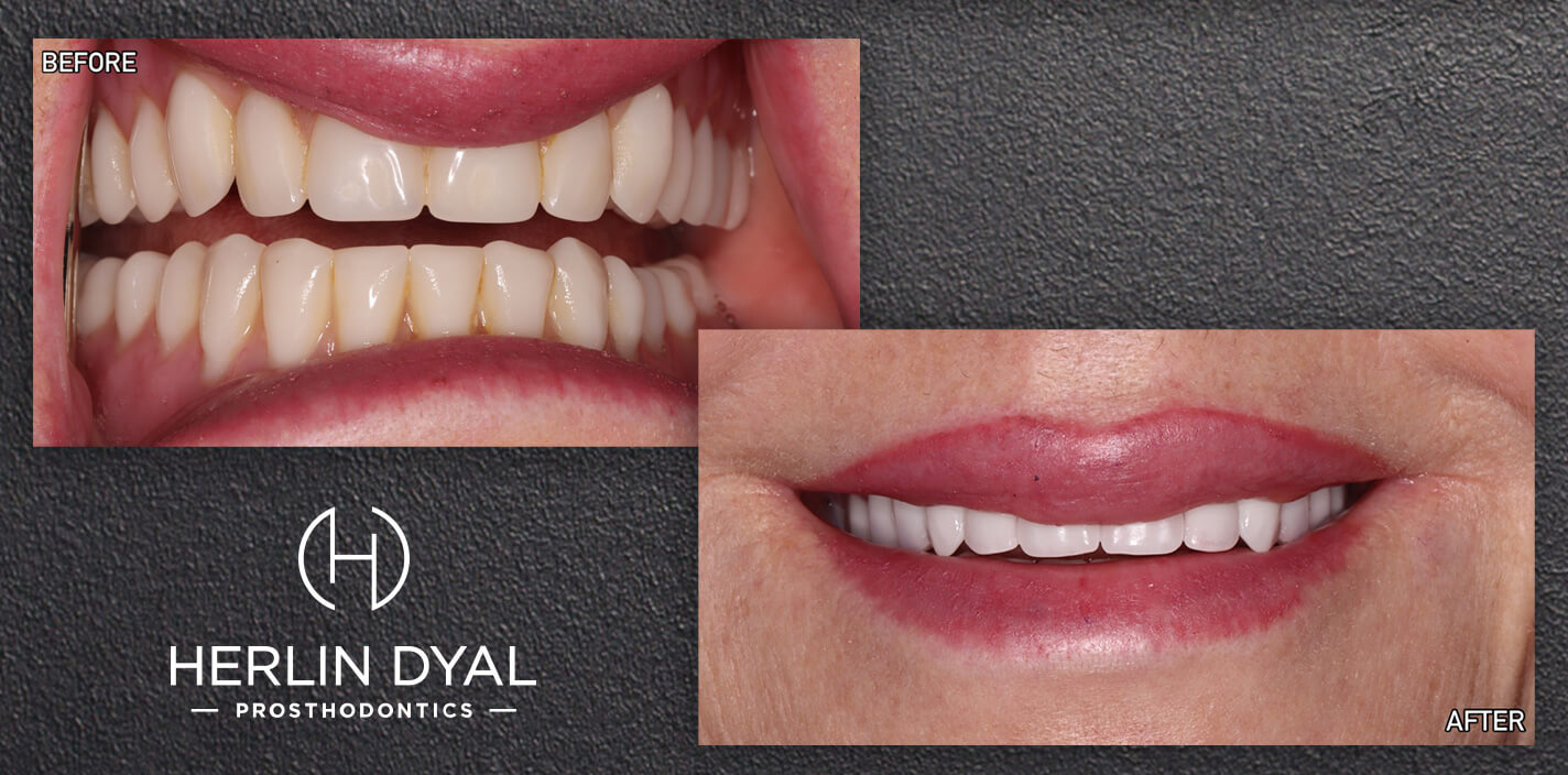 Time for an Upgrade? Replacing Old Dental Work